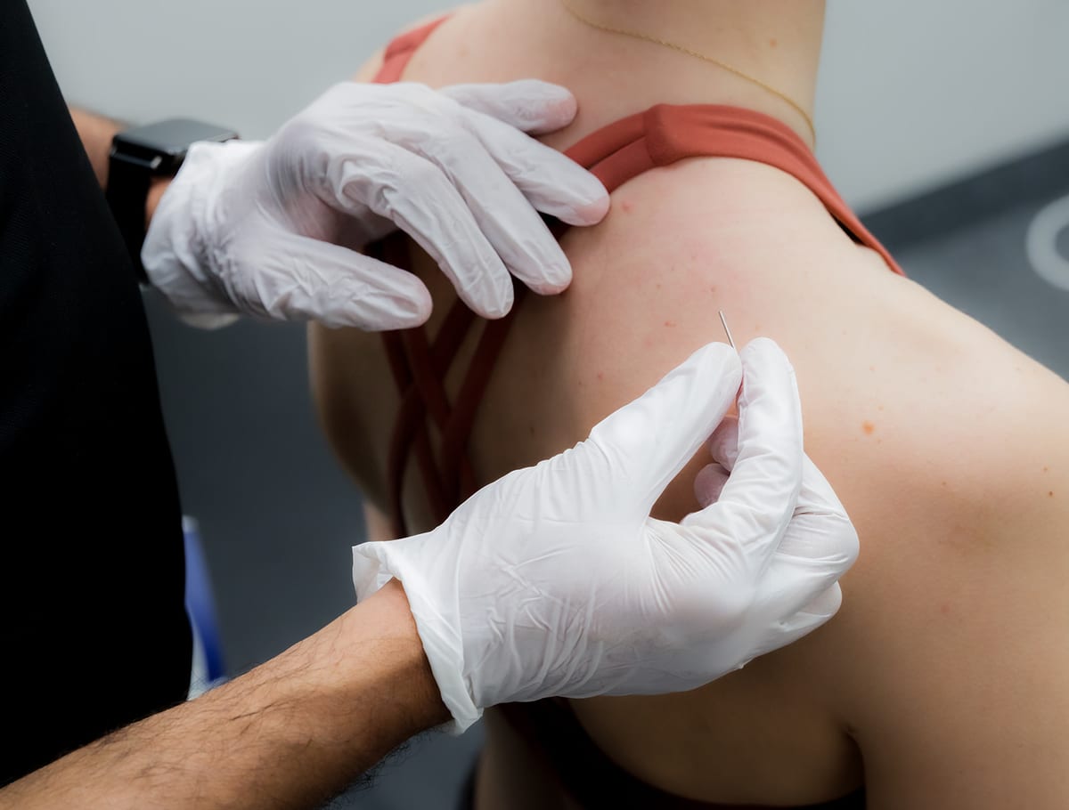 A gloved practitioner placing a fine needle into a patient's shoulder during treatment